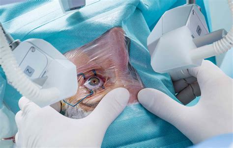 laser eye surgery procedure